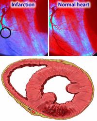Symptoms of infarction