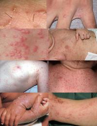 Symptoms of scabies