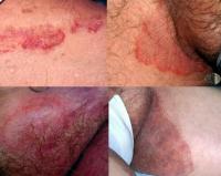 Tinea cruris