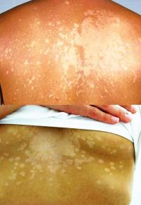 Tinea versicolor