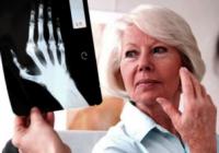 Treatment of arthritis