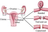 Tubal ligation