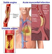 Types of heart pain