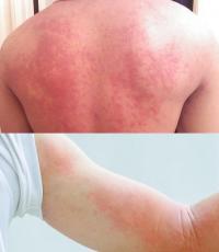 Urticaria symptoms