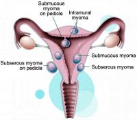 Uterine myoma
