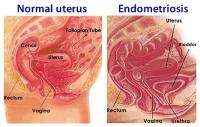 Uterus