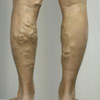 Varicose  veins