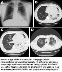 Various stages of disease