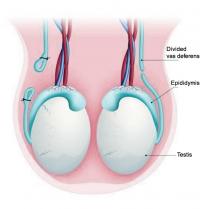 Vasectomy