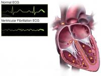Ventricular fibrillation