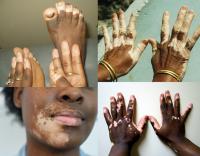 Vitiligo symptoms