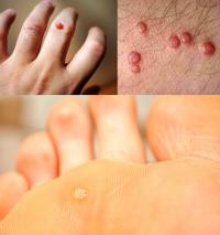 Warts