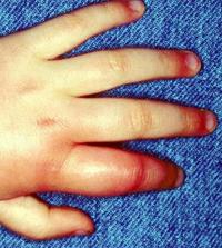 Wasp bite swelling