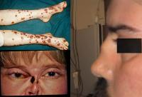 Wegener`s granulomatosis