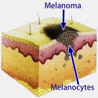 What is melanoma