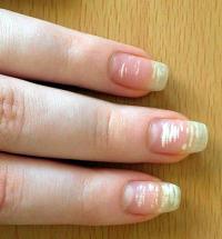 White spots on nail
